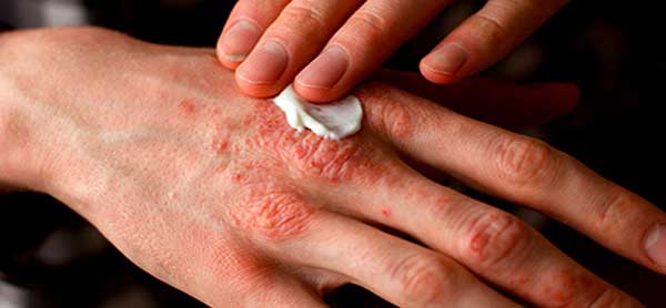 Topical Treatment For Psoriasis