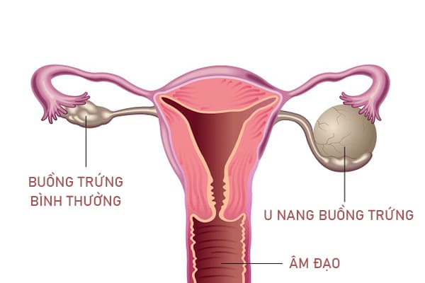 U nang buồng trứng được chia thành hai dạng là u nang thực thể và u nang cơ năng