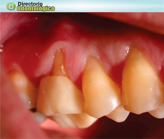 Recesión Gingival