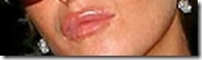 lindsay botox