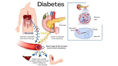 What is Diabetes
