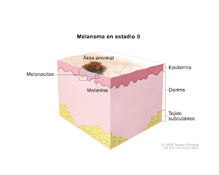 Melanoma cáncer de piel 