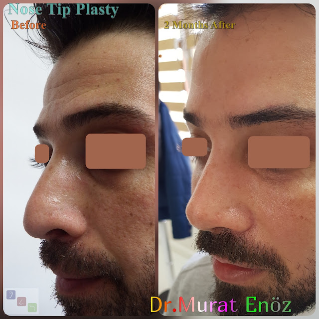 Before and 2 Months After Nose Tip Plasty in Men