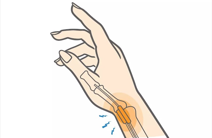 De Quervain Tenosinoviti Nedir? Risk Faktörleri Nelerdir?