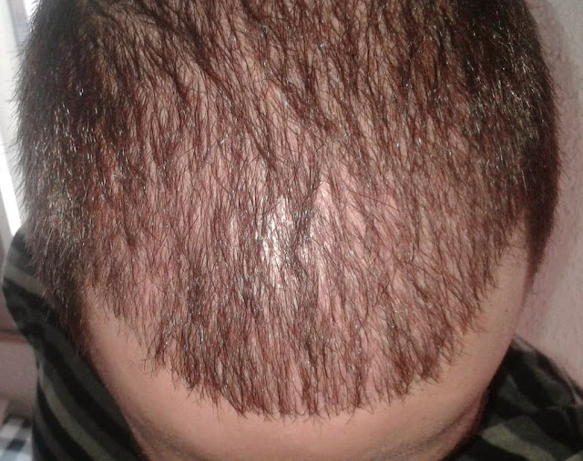 Alopecia difusa en hombre joven 