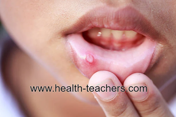 Blisters in the mouth why? Health-Teachers