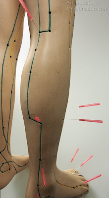 Other Sciatica Acupuncture Points: S1 Nerve Root Involvement (L5/S1)