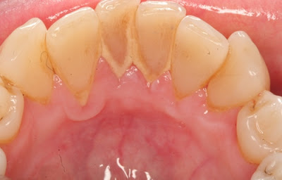 Cạo vôi răng dưới nướu có chảy máu không?