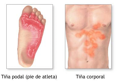 Resultat d'imatges de enfermedades micosi