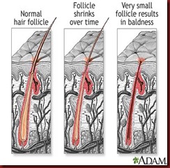 A healthy hair follicle to a bad hair follicle
