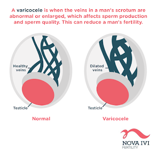 varicocele and male infertility