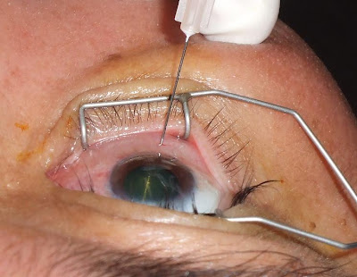 blood vessels burst in eye. Blood Vessels In The Eye -