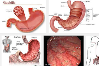 Askep Gastritis