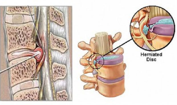 thoát vị đĩa đệm