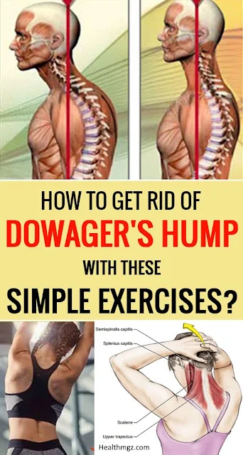 How To Get rid of Dowager’s Hump With This Simple Exercises?