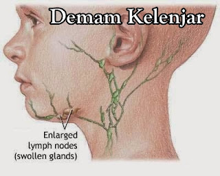 Penyakit Demam Kelenjar