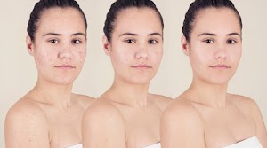 Top 10 Acne Myths