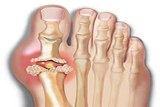 Cara mengobati asam urat pada kaki secara alami, cara alami mengatasi asam urat dan kolesterol, asam urat obat alaminya apa, air kelapa menurunkan asam urat, obat paling mujarab untuk penyakit asam urat, asam urat bisa dipijat atau tidak, pantangan pada asam urat, gangguan fungsi ginjal asam urat, obat alami untuk mengobati penyakit asam urat, mengobati asam urat dengan semut jepang, gejala asam urat pada ibu hamil