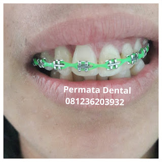 gambar foto behel bracket kawat gigi sebelum dan sesudah perawatan untuk memperbaiki merapikan gigi gingsul gigi miring renggang tonggos berantakan keluar masuk jarang diastema maju mundur tidak rapi tidak beraturan bali denpasar banyuwangi jember tidak rata kocar kacir