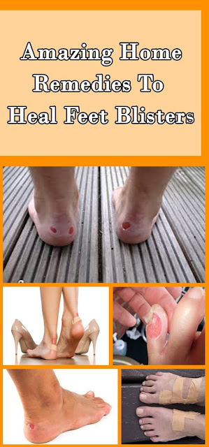 Home Remedies For Feet Blisters !!!