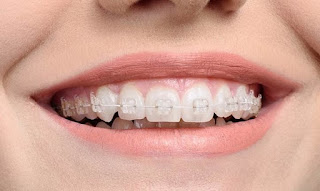 Niềng răng 1 hàm có được không-2