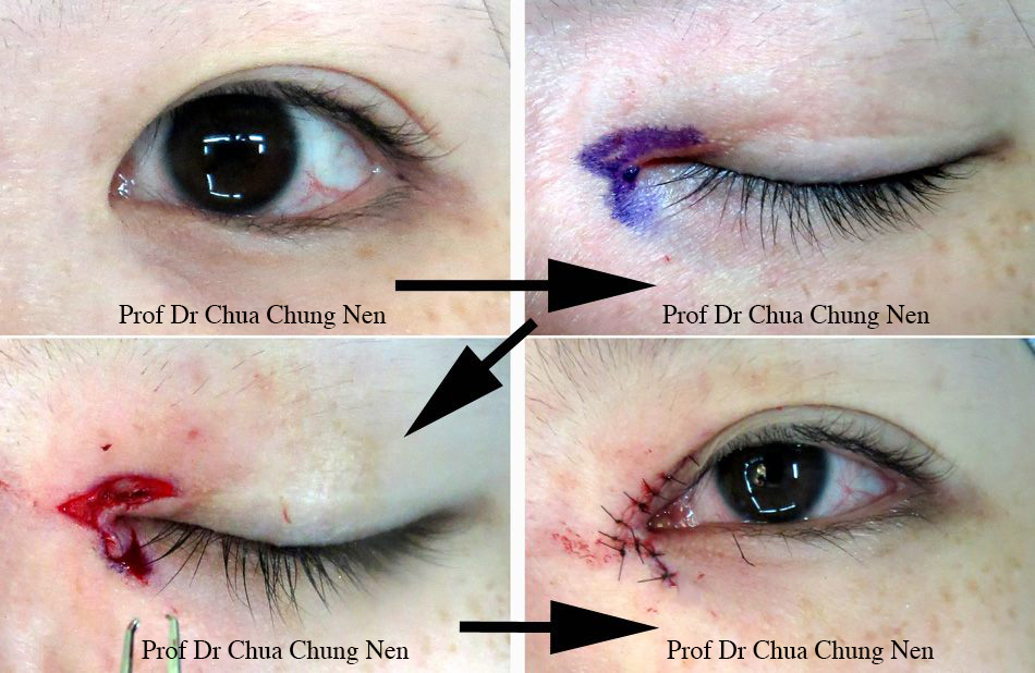 Eyelid Surgery by Prof Dr CN CHUA 蔡鐘能: Doc, Do I Need Operation on My