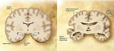 Comparison of a normal aged brain (left) and an Alzheimer's patient's brain (right). Differential characteristics are pointed out.