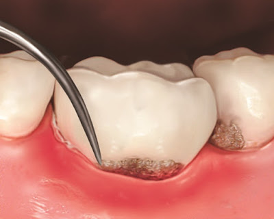 Nguyên nhân hình thành mảng bám trên răng