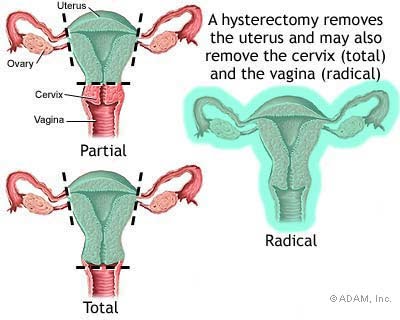 Gambar menunujukkan jenis2 hysterectomy yg akan dilakukan