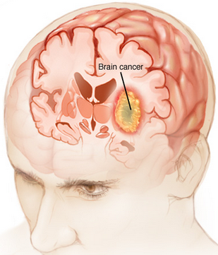 Definisi Kanker Otak dan Beberapa Tipenya