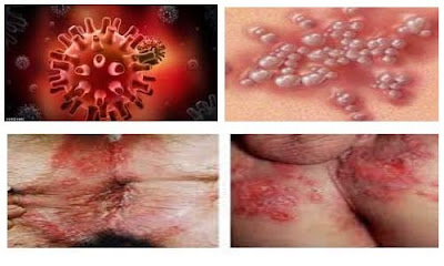 Cara Mudah Mengatasi Penyakit Herpes Tanpa Obat