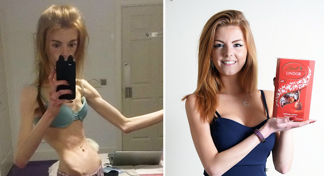 Anorexic Woman Was Transformed And Saved By Chocolates.