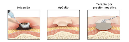 escaras, úlceras por presion