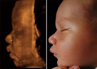 3d Baby Ultrasound