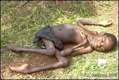 Polio Myelitis