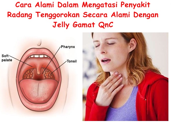 Obat Tradisional Tuntaskan Radang Tenggorokan