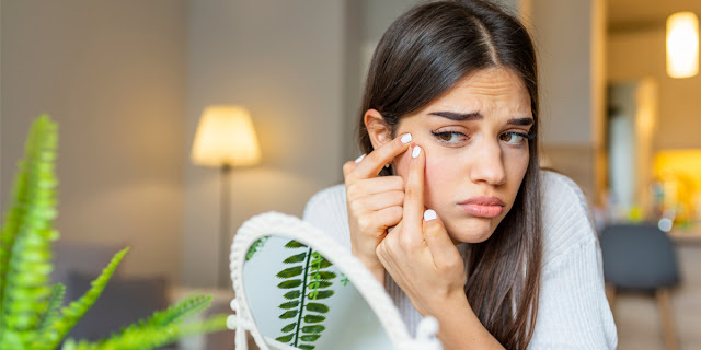 Picture of Women facing Pimple