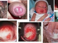 Penyakit Gonorrhea & Chlamydia