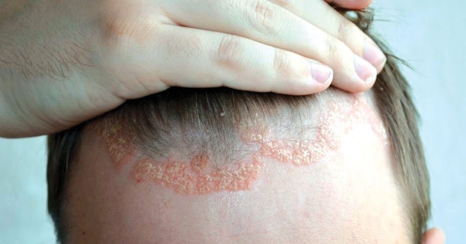 Vivix Membantu Pesakit Psoriasis Kembali Ceria dan Sihat 