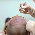 What Is The Success Rate Of Hair Transplant?