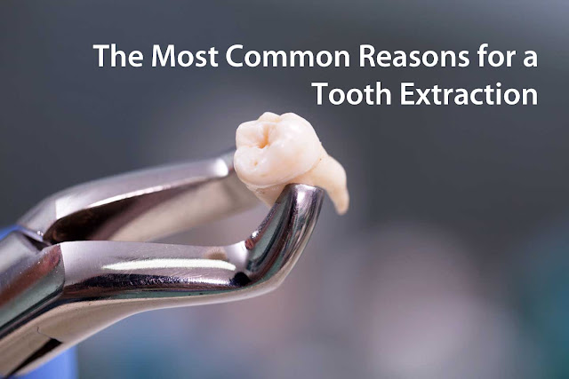 The Most Common Reasons for a Tooth Extraction