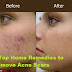 7 Top Home Remedies to Remove Acne Scars