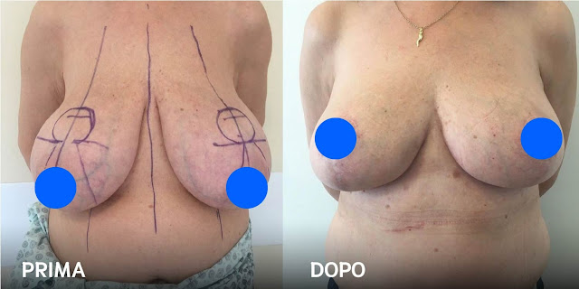 Riduzione del seno prima e dopo, di una donna di 41 anni a Tirana, albania