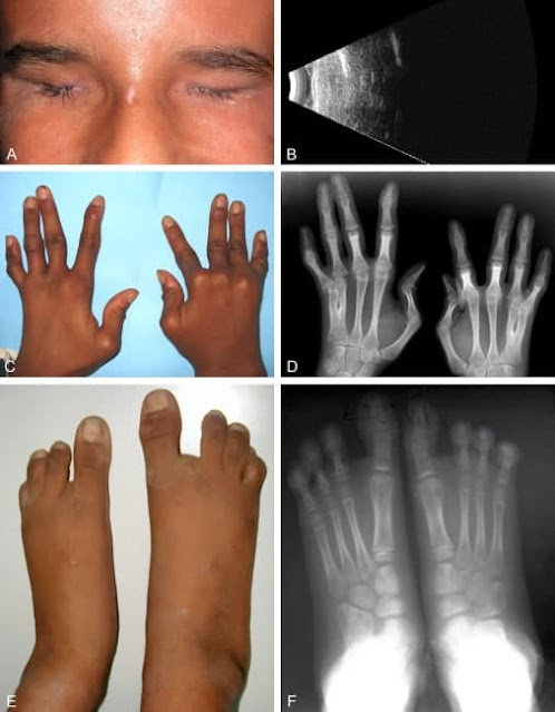 Waardenburg's anophthalmia syndrome