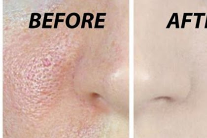 3 Days and All Open Pores Will Disappear From Your Skin Permanently