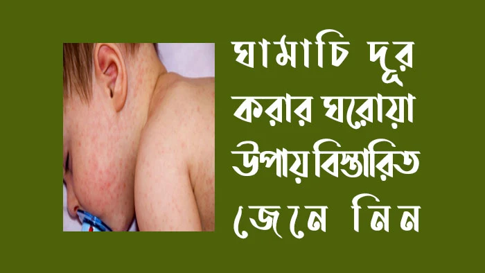 ঘামাচি দূর করার ঘরোয়া উপায়