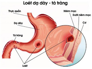 Loét hành tá tràng