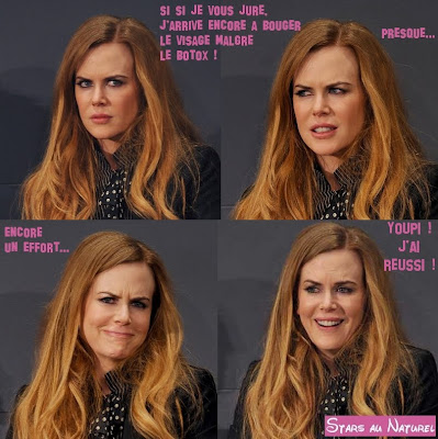 nicole kidman botox