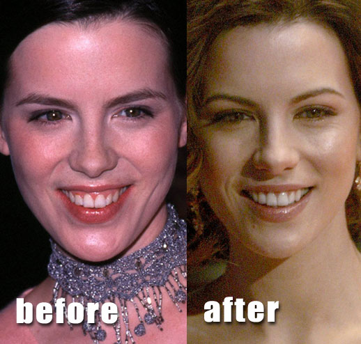 megan fox plastic surgery before. This is the efore