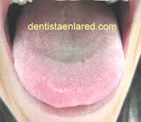 <Img src="Imagen_lengua_sana.jpg" width = "300" height "240" border = "0" alt = "Lengua de aspecto saludable con glosodinia">